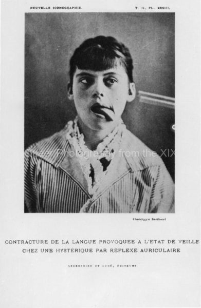 53_Laufenauer-Contracture-of-the-tongue-provoked-by-the-frequency-of-a-tuning-fork-Nouvelle-Iconographie-1889.